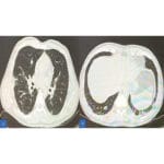Uncommon signs, critical vigilance in scrub typhus